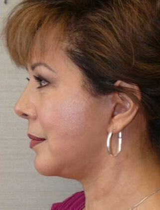 Facelift Before & After Image