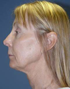 Facelift Before & After Image