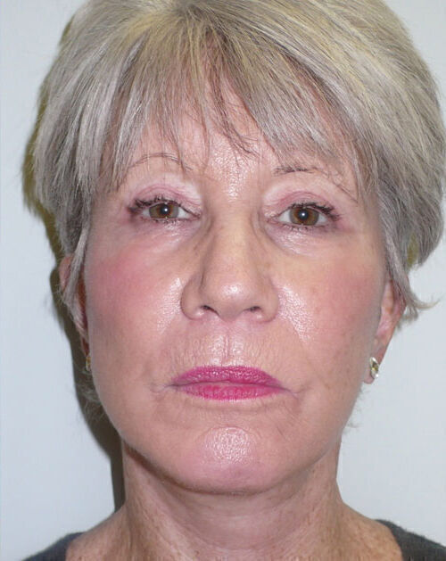 Facelift Before & After Image