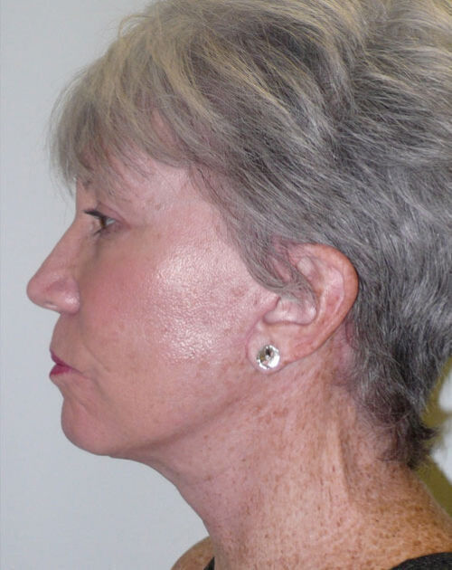 Facelift Before & After Image