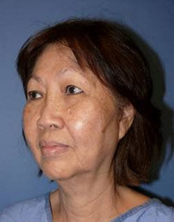 Facelift Before & After Image