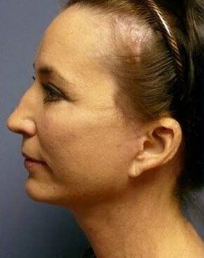 Facelift Before & After Image