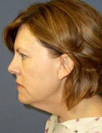 Facelift Before & After Image