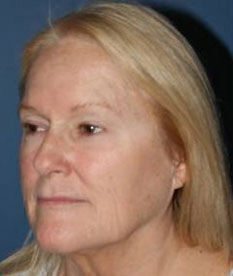 Facelift Before & After Image