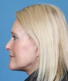 Facelift Before & After Image