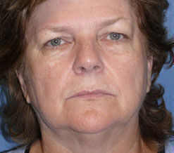 Facelift Before & After Image