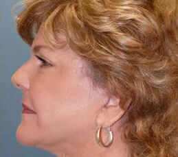 Facelift Before & After Image