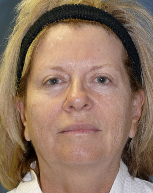 Facelift Before & After Image