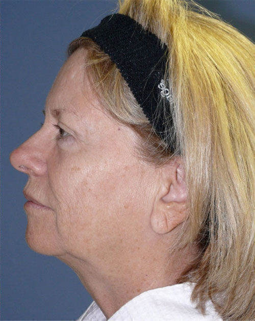 Facelift Before & After Image