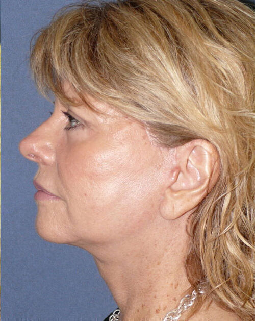 Facelift Before & After Image