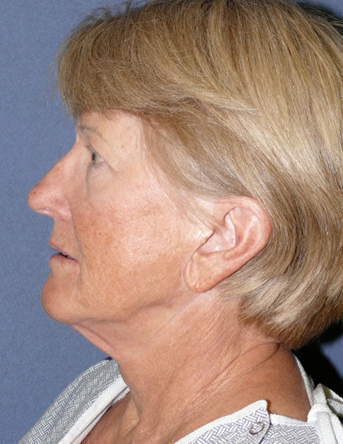 Facelift Before & After Image