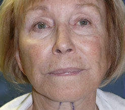 Facelift Before & After Image