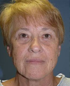 Facelift Before & After Image