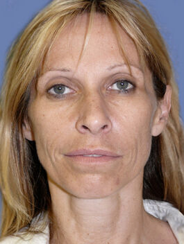 Facelift Before & After Image