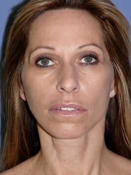 Facelift Before & After Image