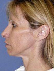 Facelift Before & After Image