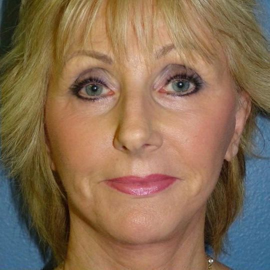 Facelift Before & After Image