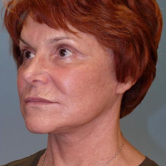 Facelift Before & After Image