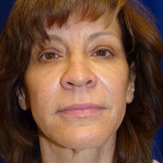 Facelift Before & After Image