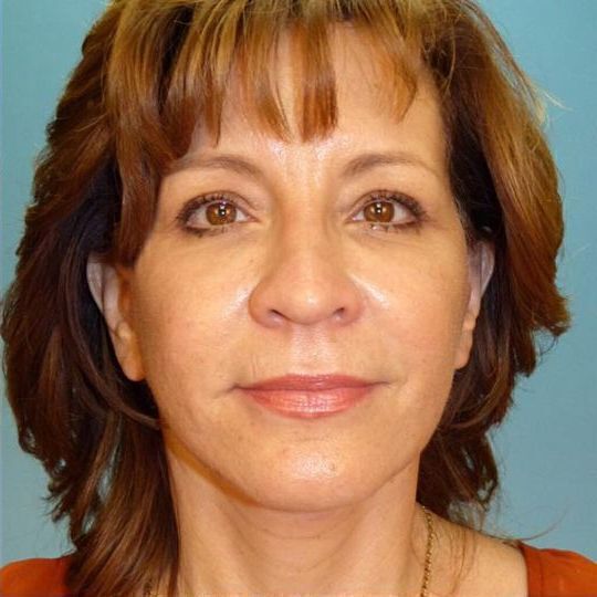 Facelift Before & After Image