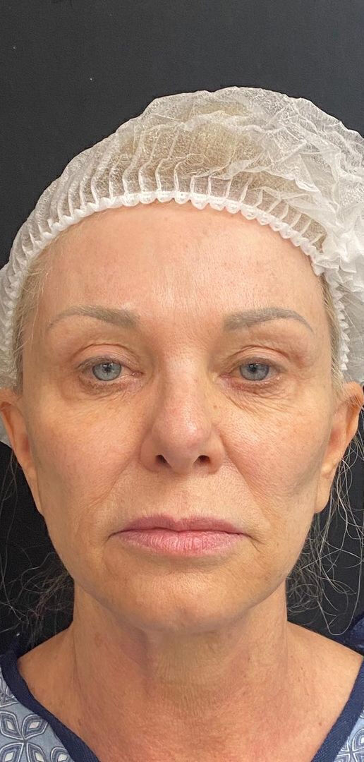 Facelift Before & After Image