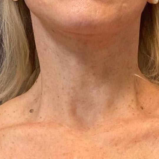 Facelift Before & After Image