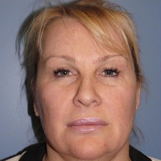 Facelift Before & After Image