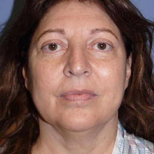 Facelift Before & After Image