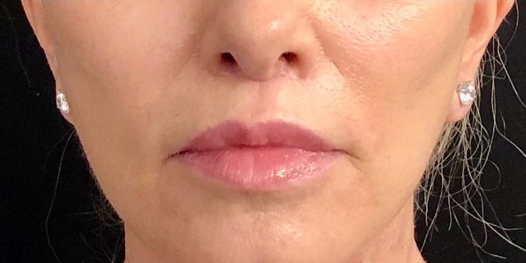 Lip Lift Before & After Image