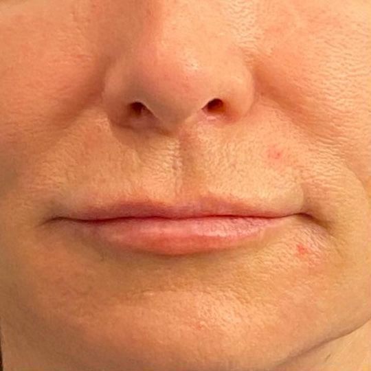 Lip Lift Before & After Image