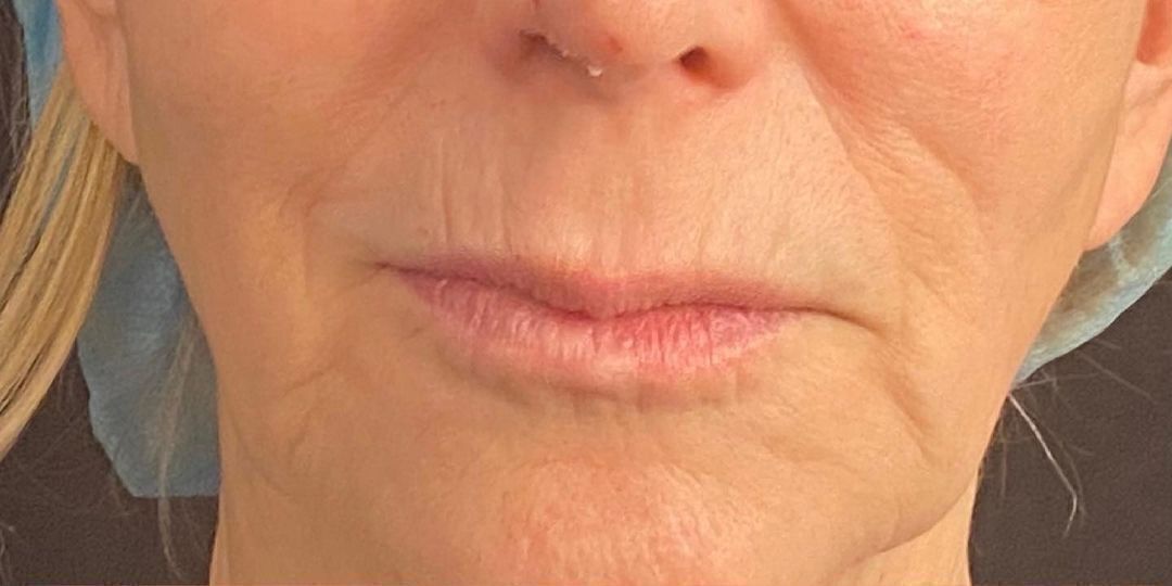 Lip Lift Before & After Image