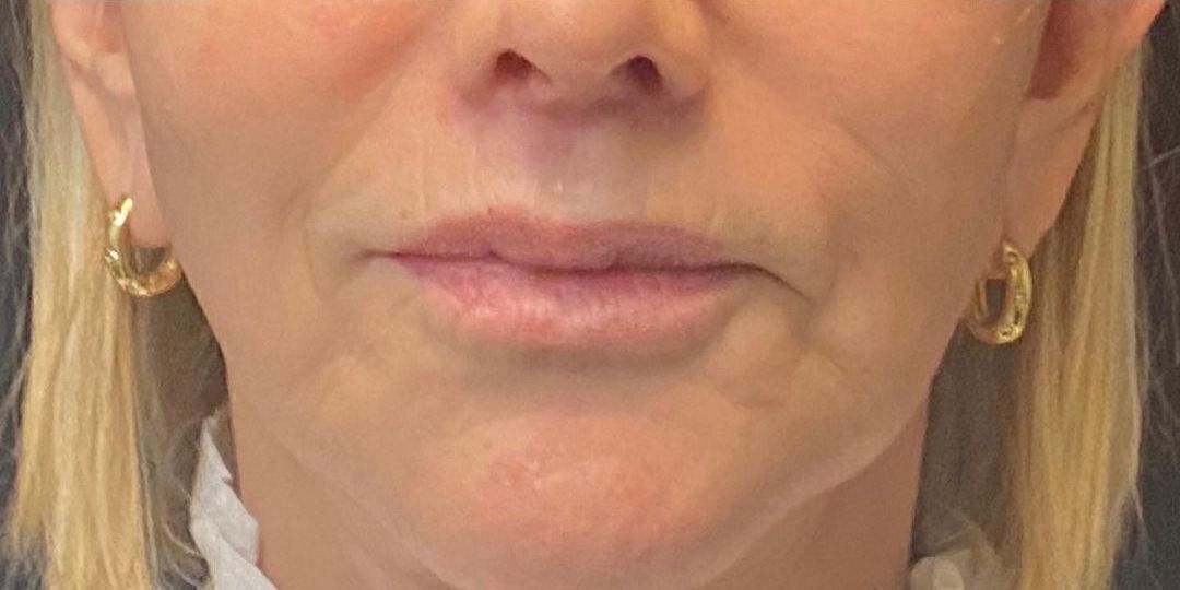 Lip Lift Before & After Image