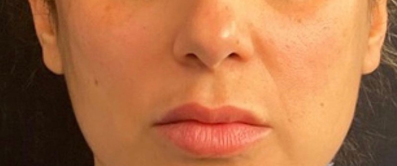 Lip Lift Before & After Image