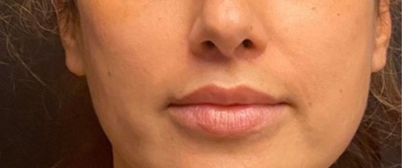 Lip Lift Before & After Image