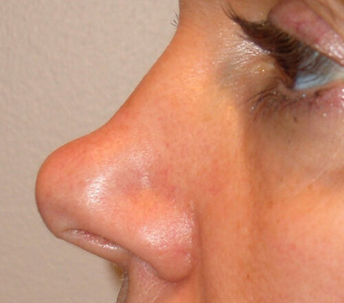 Liquid Rhinoplasty Before & After Image