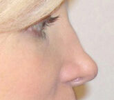 Liquid Rhinoplasty Before & After Image