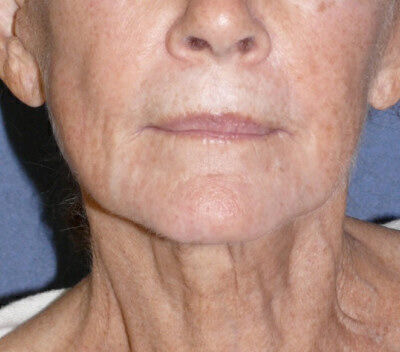 Non Invasive Before & After Image