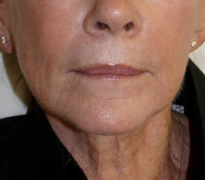 Non Invasive Before & After Image