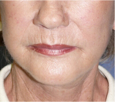 Non Invasive Before & After Image