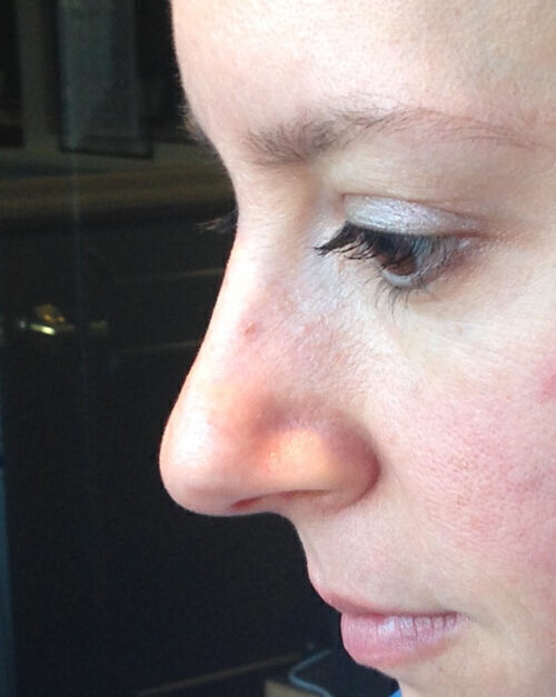 Non Invasive Before & After Image