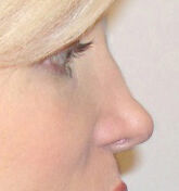Non Invasive Before & After Image