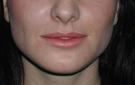 Non Invasive Before & After Image