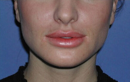 Non Invasive Before & After Image