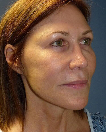 Non Invasive Before & After Image