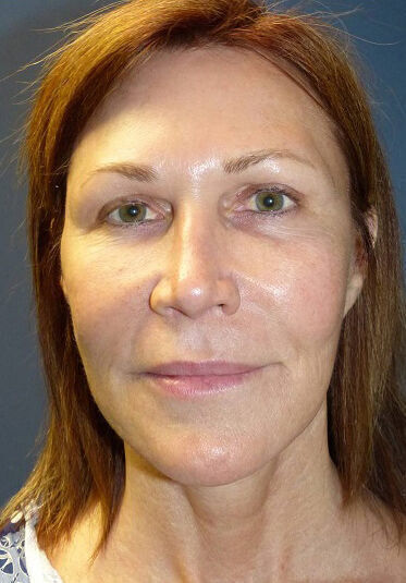 Non Invasive Before & After Image