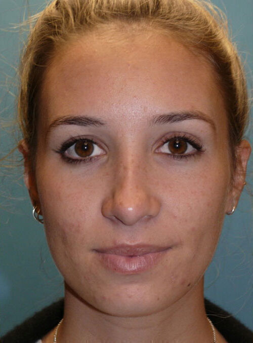 Rhinoplasty Before & After Image