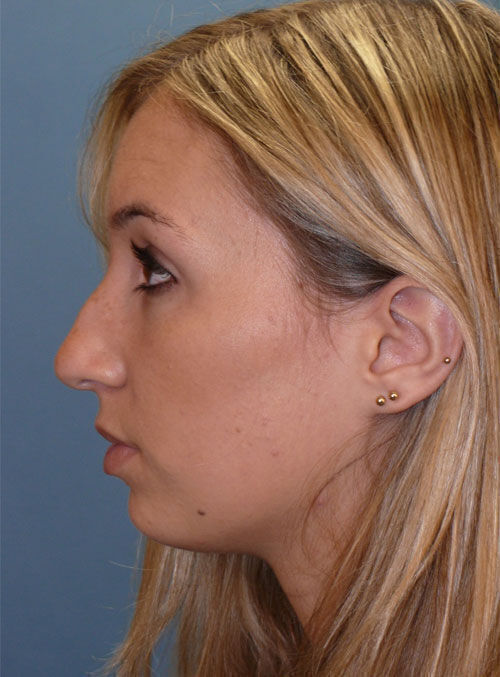 Rhinoplasty Before & After Image