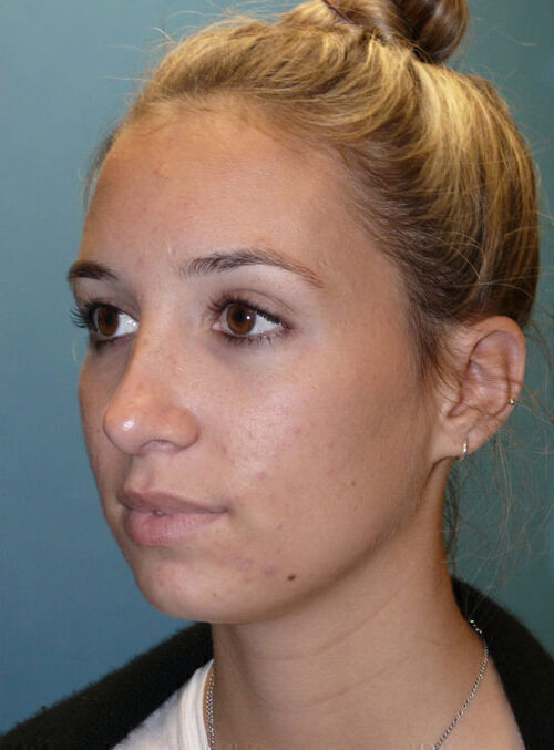 Rhinoplasty Before & After Image