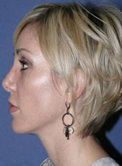 Rhinoplasty Before & After Image