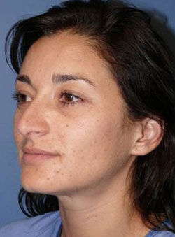 Rhinoplasty Before & After Image